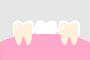 Diagram showing the components of a dental bridge, including two crowns and pontic. 