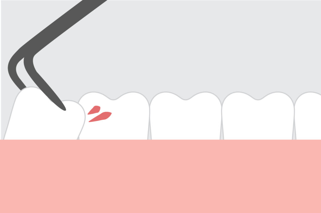 Wisdom Teeth Removal - Midwest Dental