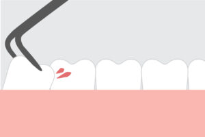 Image depicting wisdom tooth extraction with dental pliers.