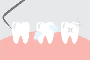 Image depicting a teeth cleaning with a dental tool and sparkling teeth, 